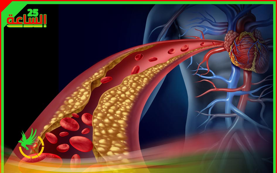 تصلب الشرايين