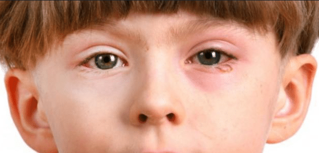 اسباب احمرار العين عند الأطفال وكيف يمكن علاجه | الساعة 25