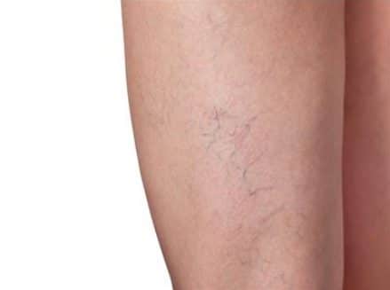 أسباب وأعراض دوالى الساقين وطرق علاجها 1 أسباب وأعراض دوالى الساقين وطرق علاجها