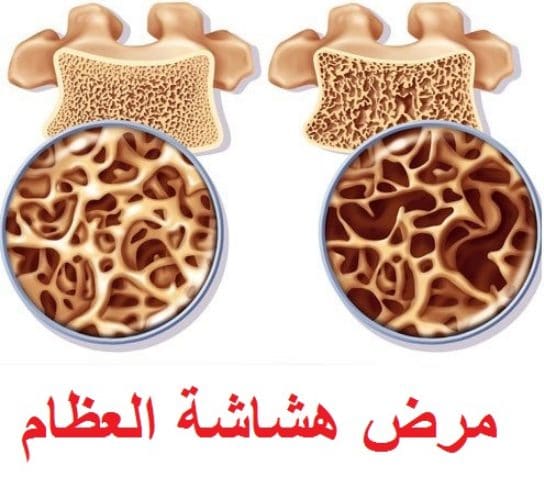 معلومات حول مرض هشاشة العظام