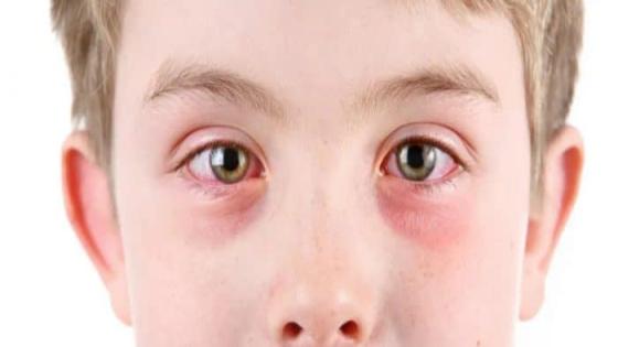 حساسية العينين عند الاطفال