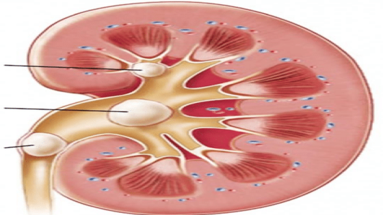 كيفية تفتيت حصوات الكلي بسرعة