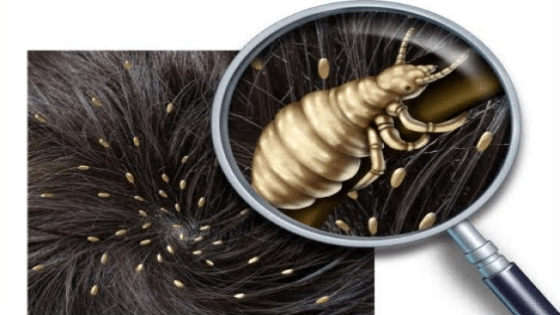 طرق التخلص من حشرات الشعر