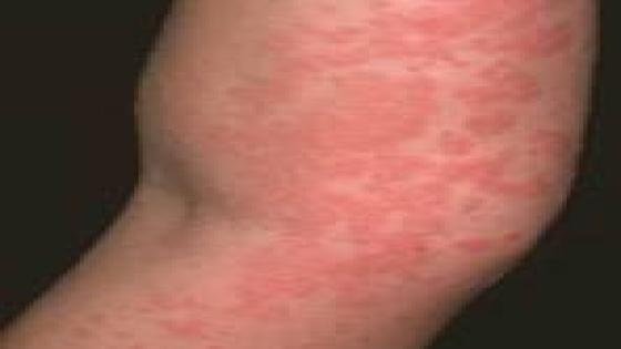 حساسية نادرة تصيب الانسان تجعل الجلد كخلية نحل