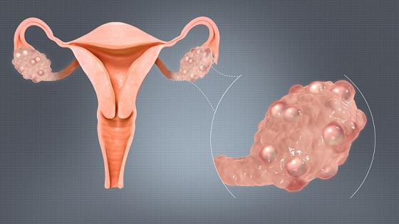 تكيسات المبيض ماهى الأعراض والأسباب والمخاطر والعلاج ؟