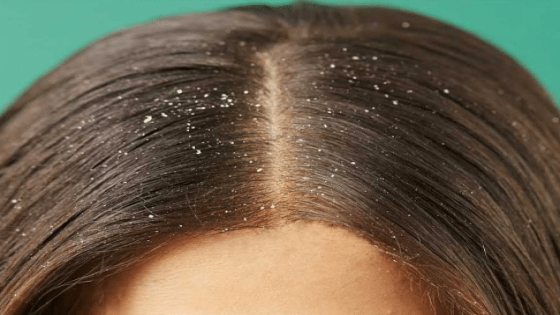 أسباب الإصابة بقشرة الشعر وطرق علاجها
