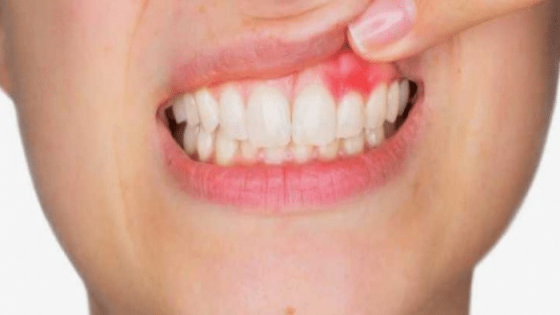 أسباب التهاب اللثة ورائحة الفم الكريهة