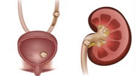 أعراض الإصابة بحصوات الكلى