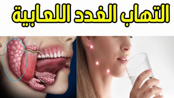 أعراض التهاب الغدد اللعابية وطرق العلاج