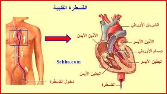 القسطرة القلبية