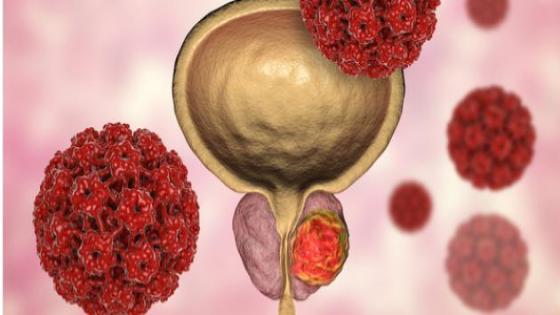 أعراض الإصابة بمرض سرطان البروستاتا