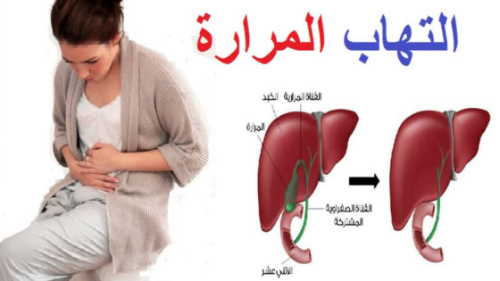 ما هى أعراض التهاب المرارة