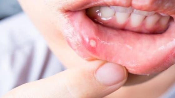ما هي أسباب قرح الفم وطرق علاجها
